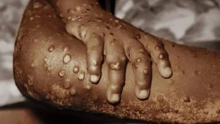 Benue Investigates Suspected Mpox Cases in Konshisha Following Community Distress Call